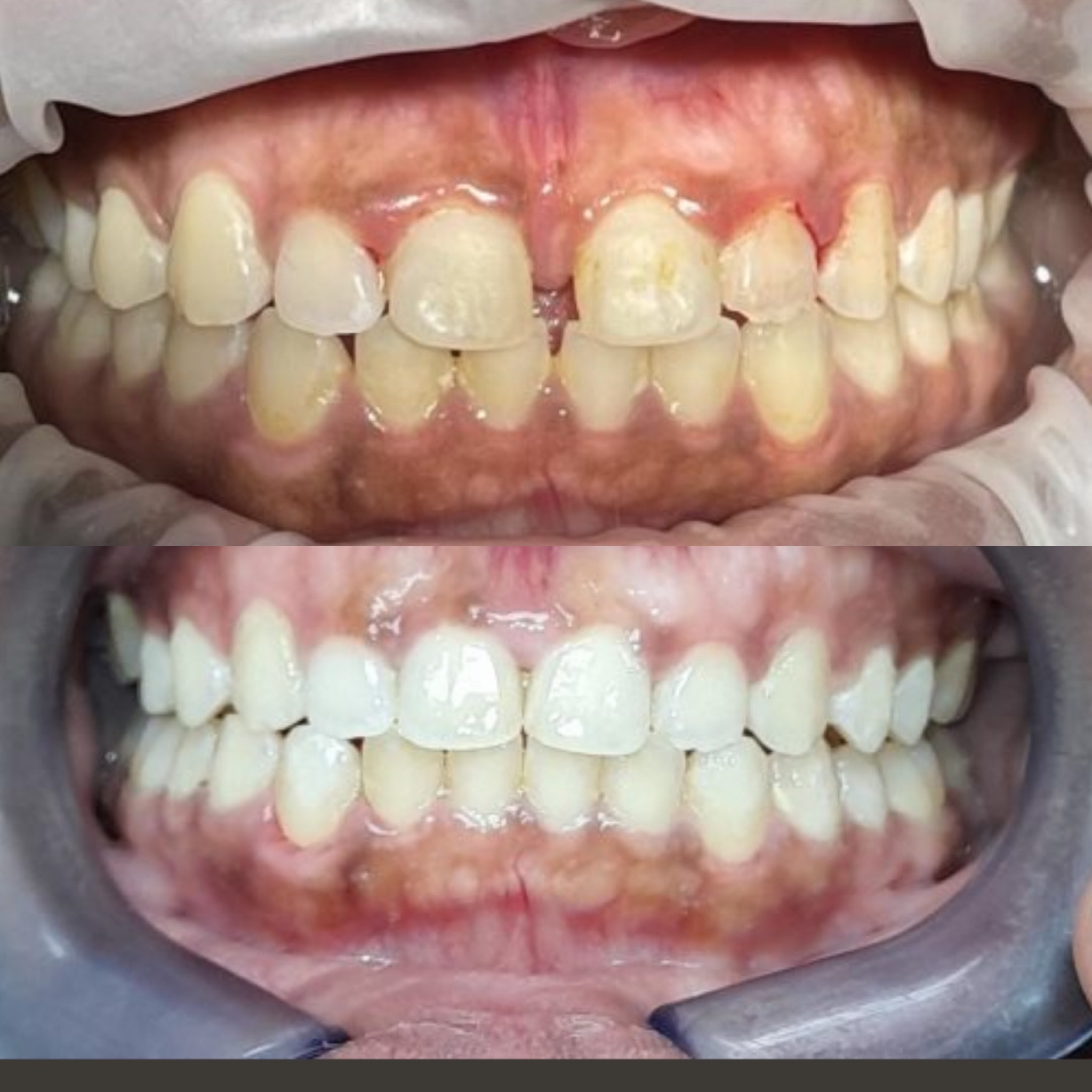 gingival